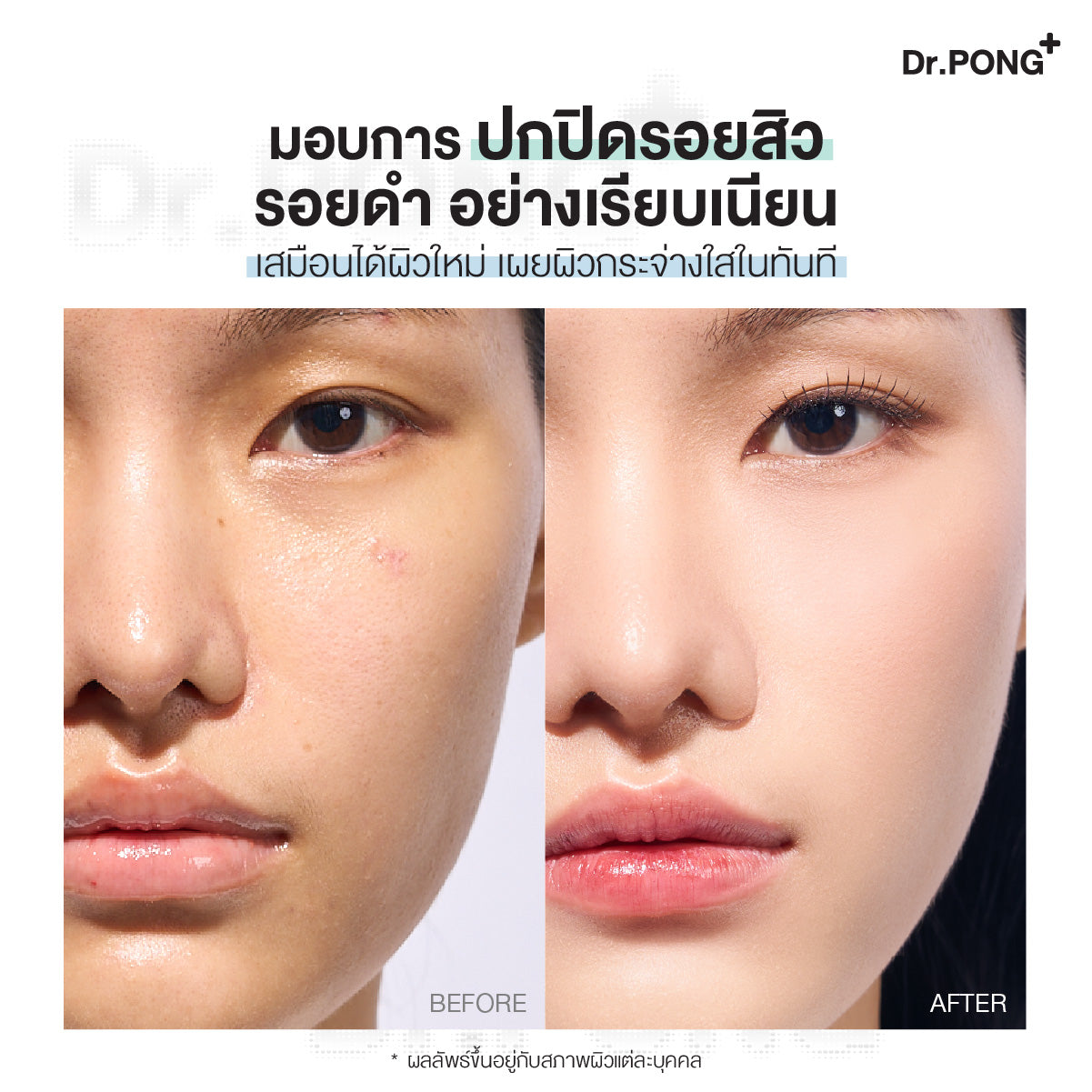 [ซื้อ1แถม1] Dr.PONG ACNE ACE LONGWEAR CUSHION